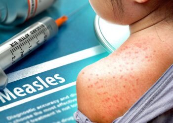 Measles Outbreak in the US Hits 25-Year High